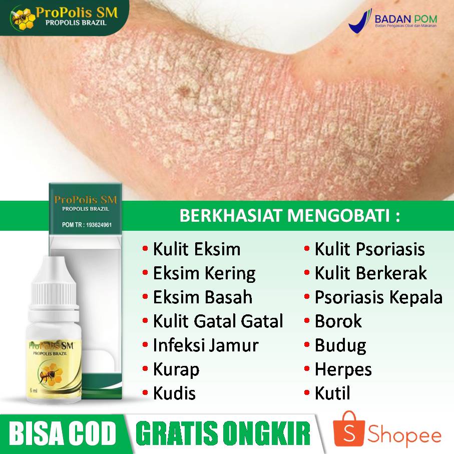 Obat Eksim, Obat Eksim Kering Menahun, Obat Eksim Basah, Obat Eksim Kurap, Obat Psoriasis, Obat Psor