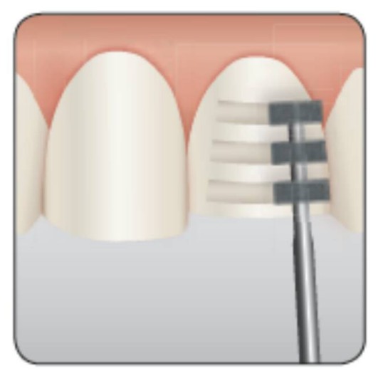 

Dental Jaya Bur Veneer // Deep marker // Diamond Bur