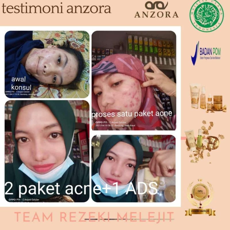 REMOVER ACNE DARK SPOT ANZORA