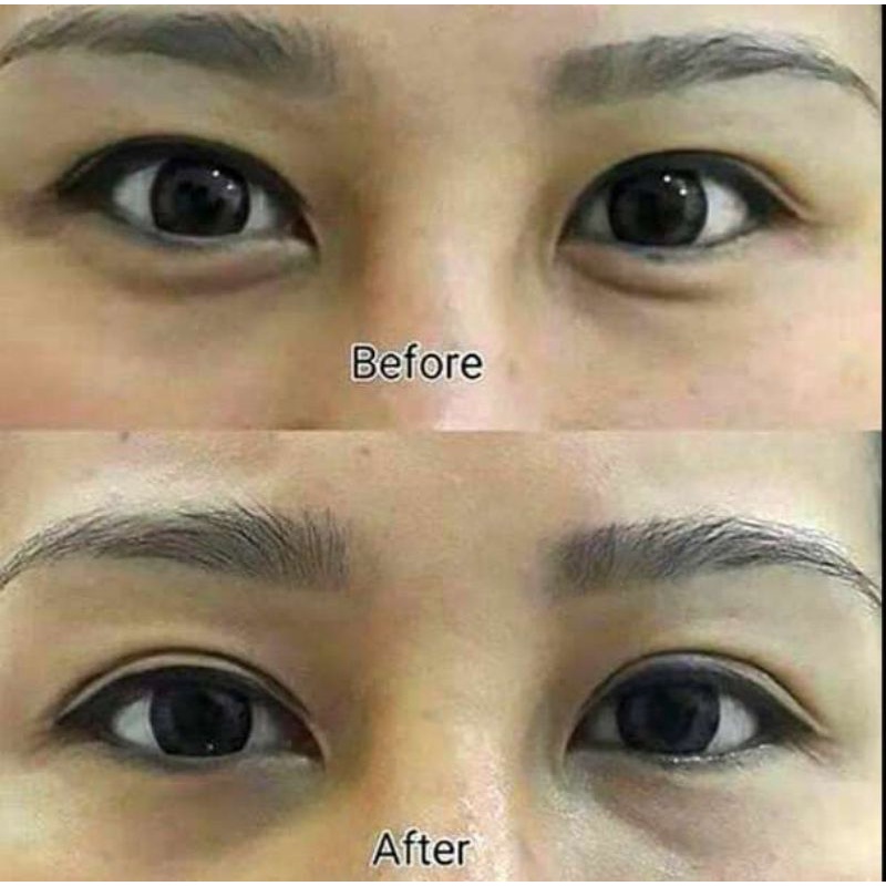 3 KALI OLES HILANG PERMANEN PENGHILANG MILIA & KANTUNG MATA