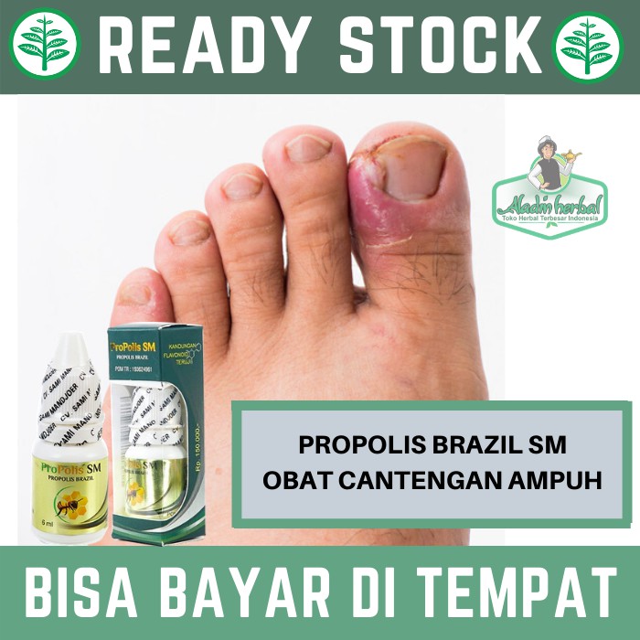 Propolis Brazil Sm Obat Cantengan Jamur Kuku Kutil Herpes Ketombe