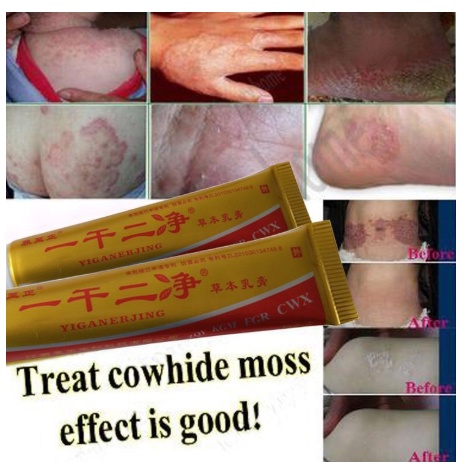 yiganerjing cream Eksim Psoriasis Dermatitis Jerawat Infeksi jamur dll