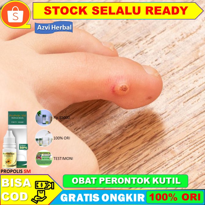 Obat Papiloma, Penghilang Papiloma, Perontok Kutil, Papiloma di Leher dan Wajah - Propolis SM