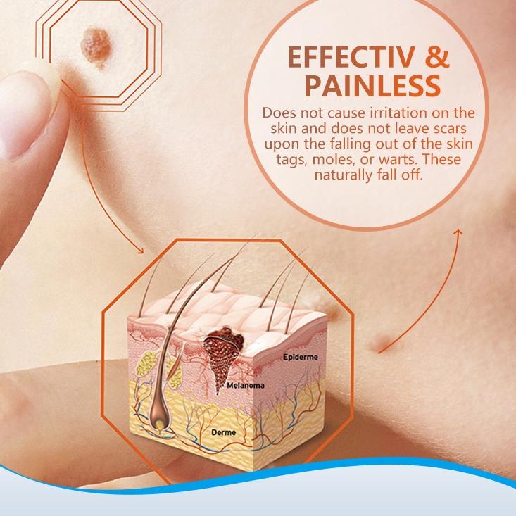 Warts Remover Cream Wart Treatment Skin Tags Mole Remover Plaster Cream Antibacterial Foot Wart Oint
