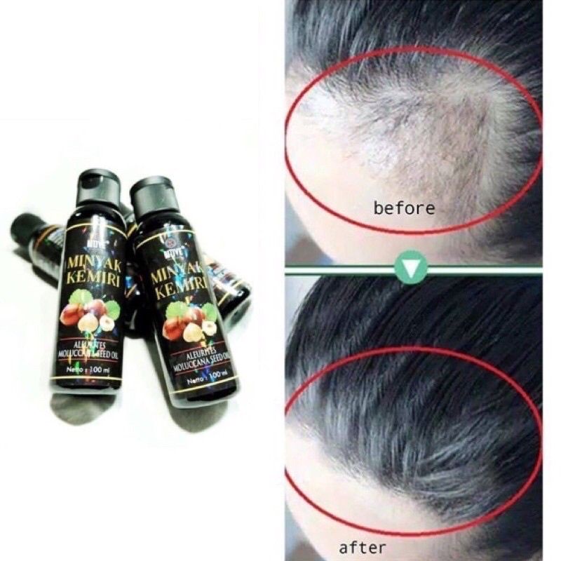 COD FREEONGKIR MINYAK KEMIRI HITAM ORIGINAL PENUMBUH RAMBUT BOTAK DAN PELEBAT RAMBUT BPOM