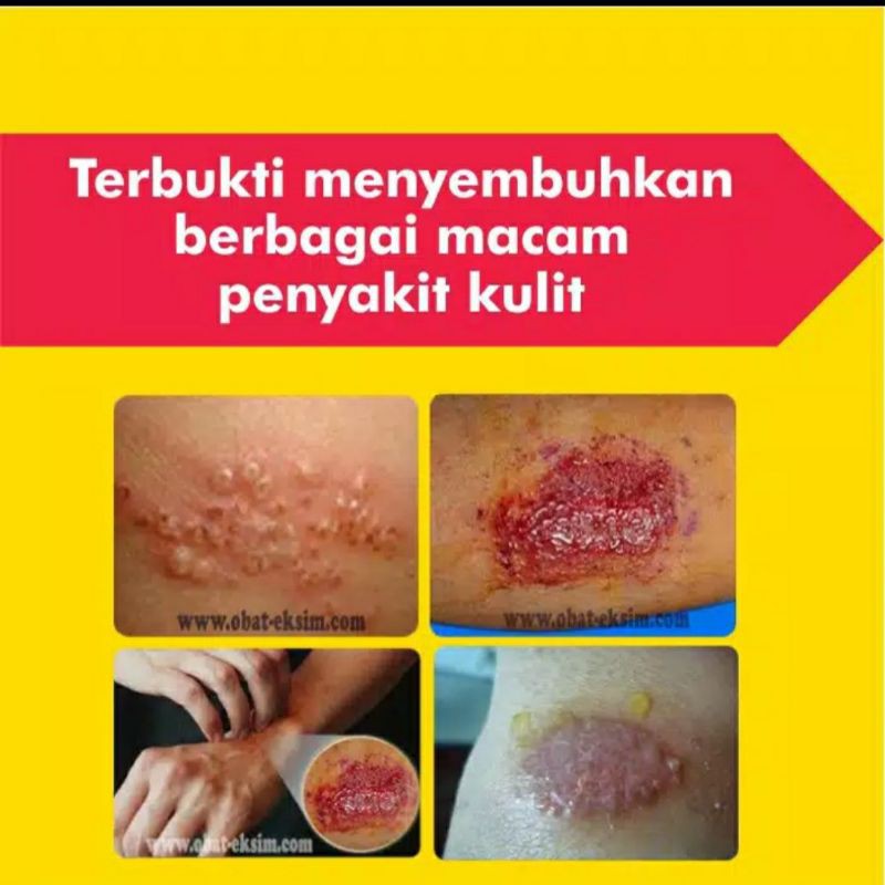 SALEP KULIT GATAL | KURAP MENAHUN | SELANGKANGAN | EXIM /EKSIM MENAHUN | ASLI EMPEDU ULAR SANCA