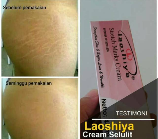 Stretch Mark Cream Penghilang Strechmark Pantat Selulit Ampuh Laoshiya Body Lotion