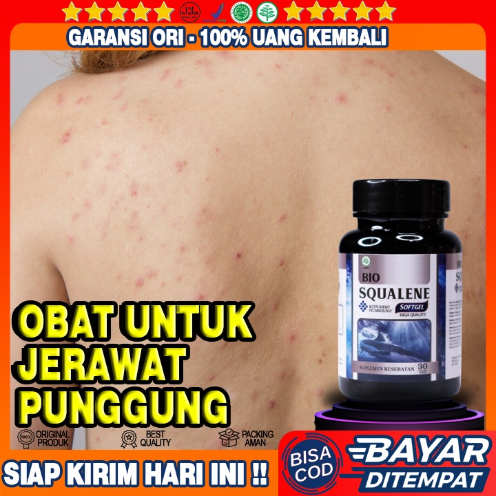 Obat Jerawat Batu Punggung - Obat Jerawat Punggung - Obat Bekas Jerawat Punggung - Obat Bintik Merah