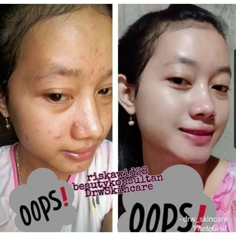 Paket Radiant Acne Drw skincare/Cream acne/Wajah berjerawat/Acne gLowing