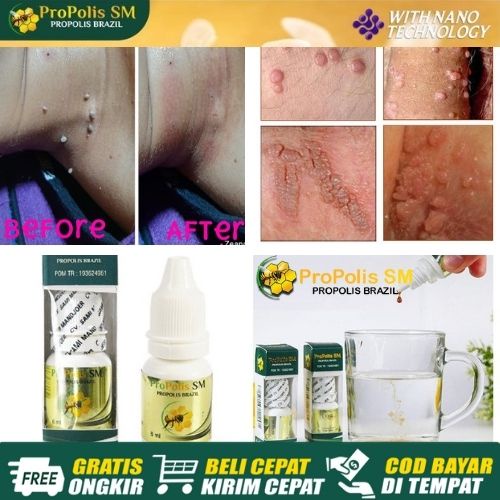 Obat Papiloma Leher - Papiloma Parasit di Leher - Obat Penghilang Kutil Papiloma di Leher | Propolis