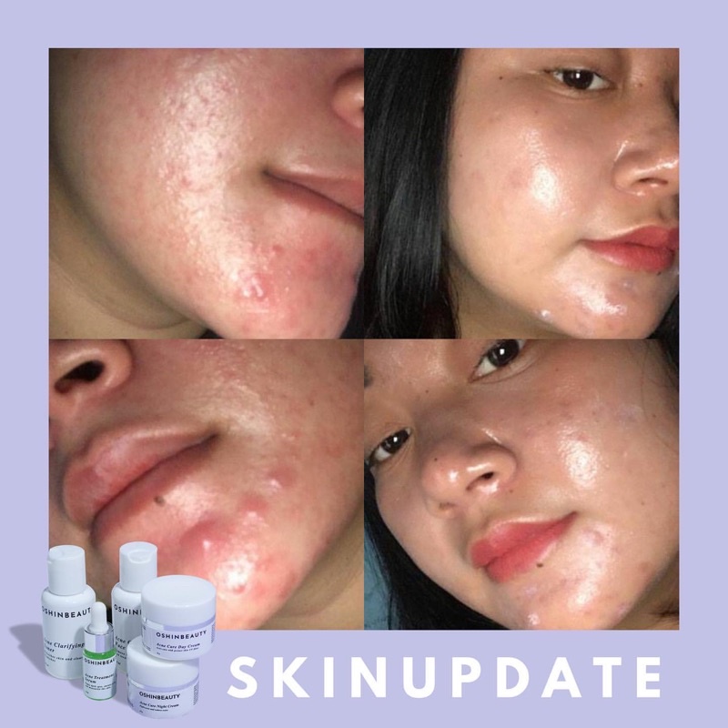 (ECER ACNE) OshinBeauty - Acne Series Oshin Beauty Skincare [Free Gift]-3