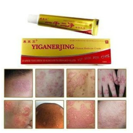 yiganerjing cream Eksim Psoriasis Dermatitis Jerawat Infeksi jamur dll