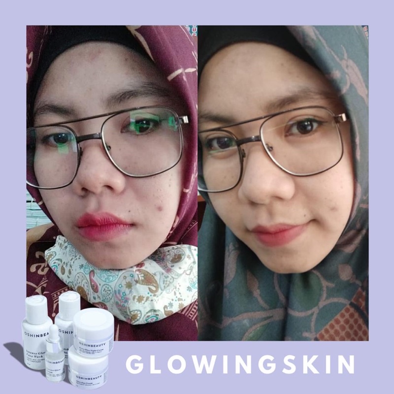 (OSHINBEAUTY) Paket Skincare Glow dan Acne Series Complete BPOM [Free Gift/Bonus]-5