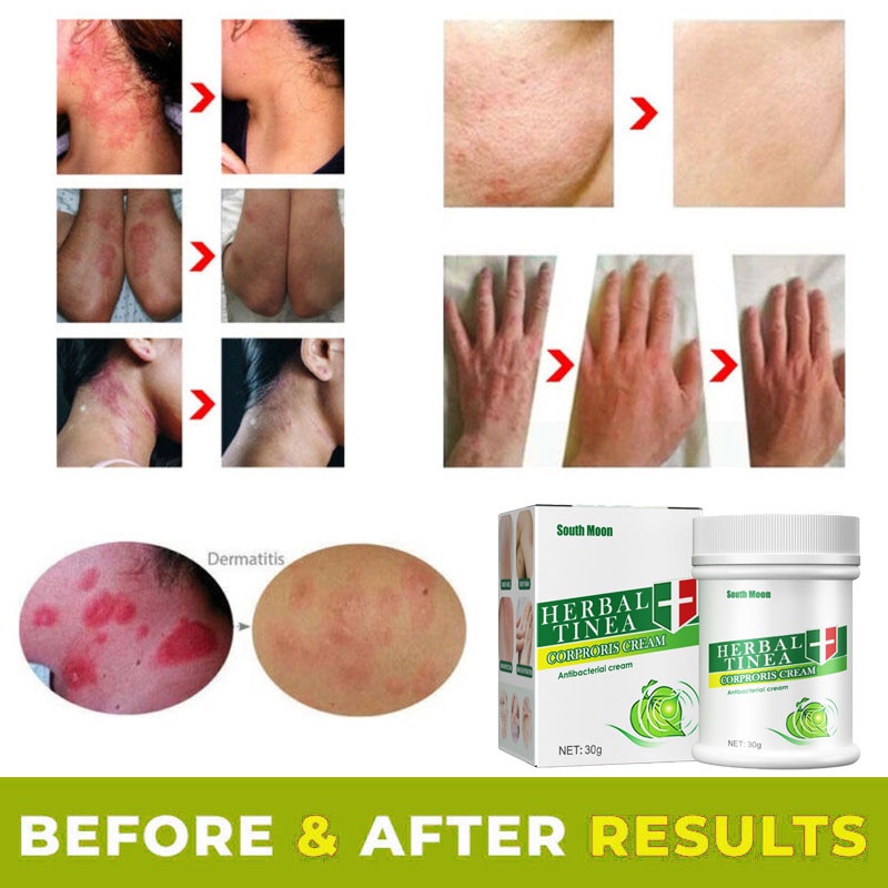 Salep gatal Salep Eksim Salep kulit Krim psoriasis paling ampuh Kulit Kepala Psoriasis Tangan Tinea Kaki Bau Versicolor Menghambat Dermatitis Jamur Anti Gatal Cream 30G