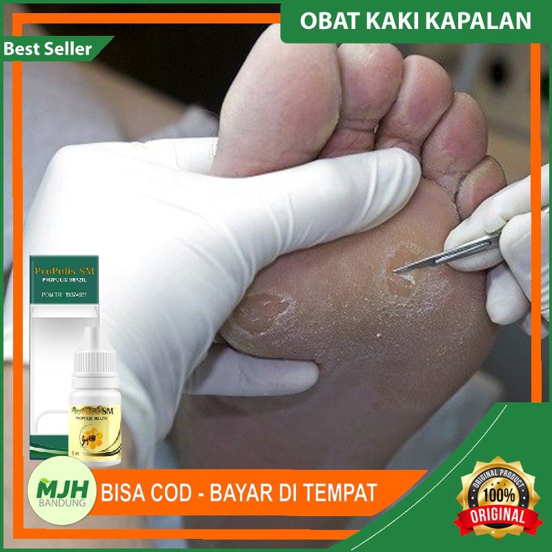 Obat Telapak Kaki Rayapan - Penghilang Kaki Berlubang / Bolong Bolong - Kapalan