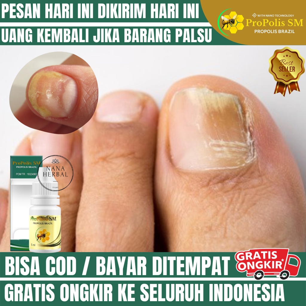Obat Jamur Kuku, Obat Infeksi Jamur Kuku, Obat Kuku Kuning, Obat Kuku Menebal Dan Mudah Rapuh, Obat 