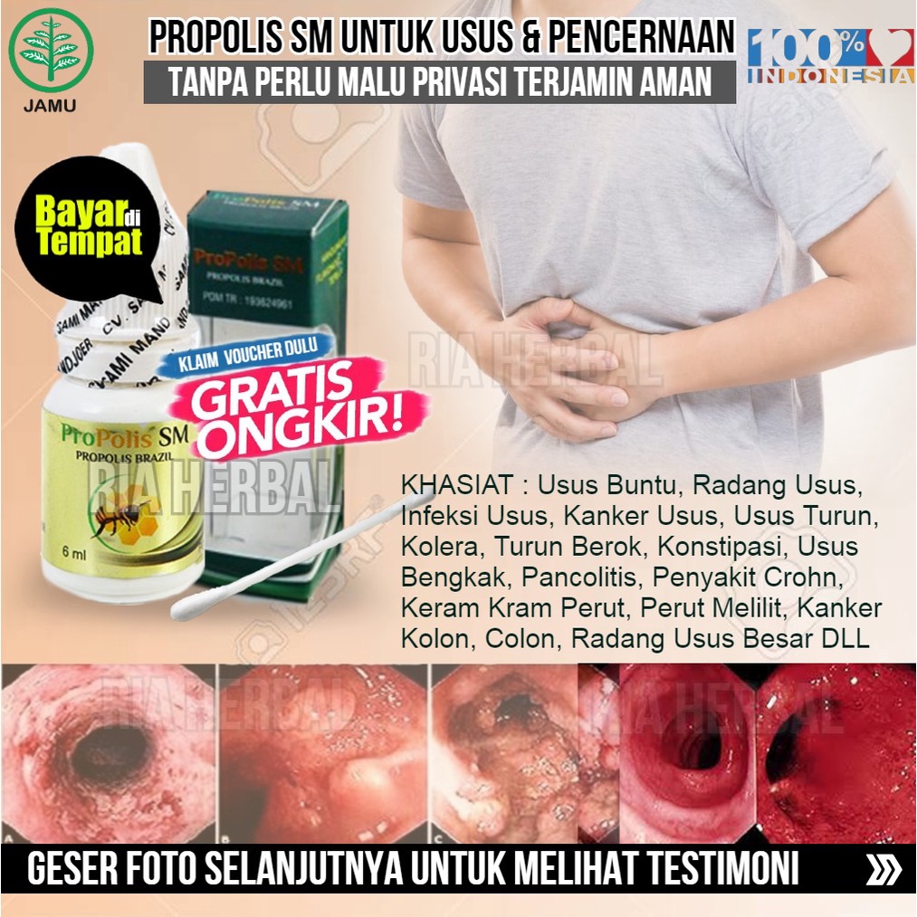 Obat Radang Usus Bab Berdarah, Radang Usus dan Lambung, Gejala Radang Usus Buntu, Obat Bab Keluar Gu