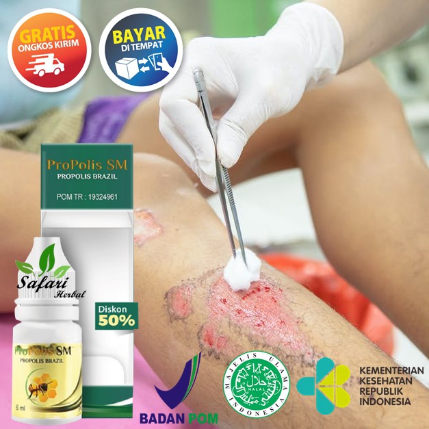 Jual Obat Penghilang Koreng Koreng Menahun Propolis Sm Obat Koreng Di Kaki Punggung