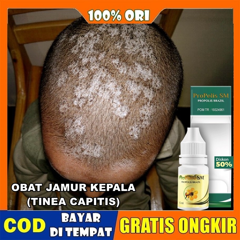 Obat Jamur Kulit Kepala, Kurap Kepala, Gatal Kulit Kepala, Infeksi Jamur Kulit Kepala - Propolis SM