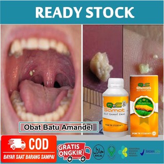 Obat Herbal Penghilang Batu Amandel Menghilangkan Batu Tonsil Sembuhkan Radang Amandel Bengkak Shopee Indonesia