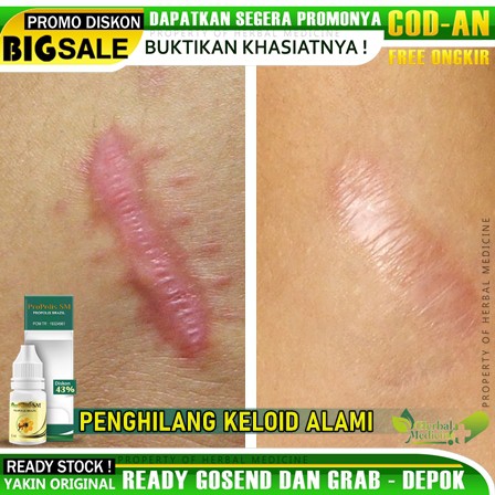 Obat Keloid, Menahun, Bekas Operasi, Penghilang Keloid, Penumpas Keloid Dengan Propolis SM 100% Aman