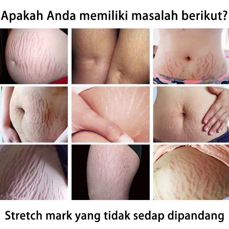 Krim Kehamilan StretchMark Cream krim bekas luka 30ml Pengencang Kulit Solusi Perut Gatal dan Anti Stretchmark Ibu Hamil Stretch Mark Krim Penghilang Stretch Mark mama choice stretch mark stretch mark