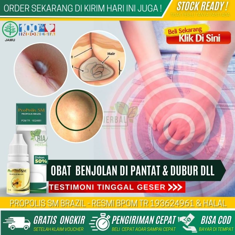 OBAT BENJOLAN DI PANTAT ANAK DAN DEWASA, PENGHANCUR BENJOLAN DI DEKAT PANTAT, OBAT BUAT BENJOLAN DI 
