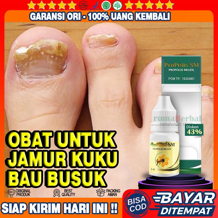 Obat Jamur Kuku Bau Busuk, Kuku Rusak, Kuku Kaki Cantengan Bernanah, Kuku Kaki Menusuk Kuku Bernanah