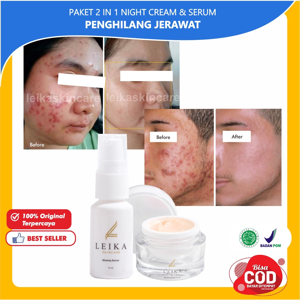 [NIGHT CREAM, SERUM] Penghilang Jerawat Dan Bekas Jerawat Penghilang Jerawat Dan Komedo Penghilang J