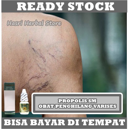 Obat Penghilang Varises Kaki, Obat Varises Kaki, Obat Varises Testis, Obat Varises Betis, Obat Penghilang Varises, Obat Untuk Menghilangkan Varises, Obat Varises Walep, Obat Varises Varius, Obat Varises Tungkai, Obat Herbal Varises Dengan Propolis SM