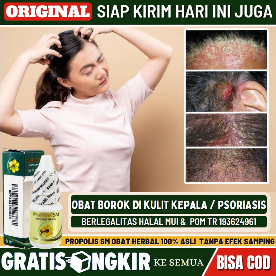 Obat Tetes Borok & Psoriasis di Kulit Kepala, Obat Tetes Borok Aman Alami Untuk Anak & Dewasa, Obat 
