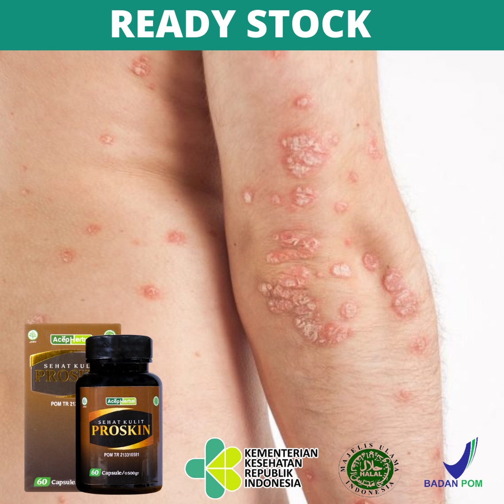 Obat Gatal Kulit Psoriasis, Kulit Kering, Obat Kulit Bersisik dan Tebal, Gatal Menahun, Obat Kulit M