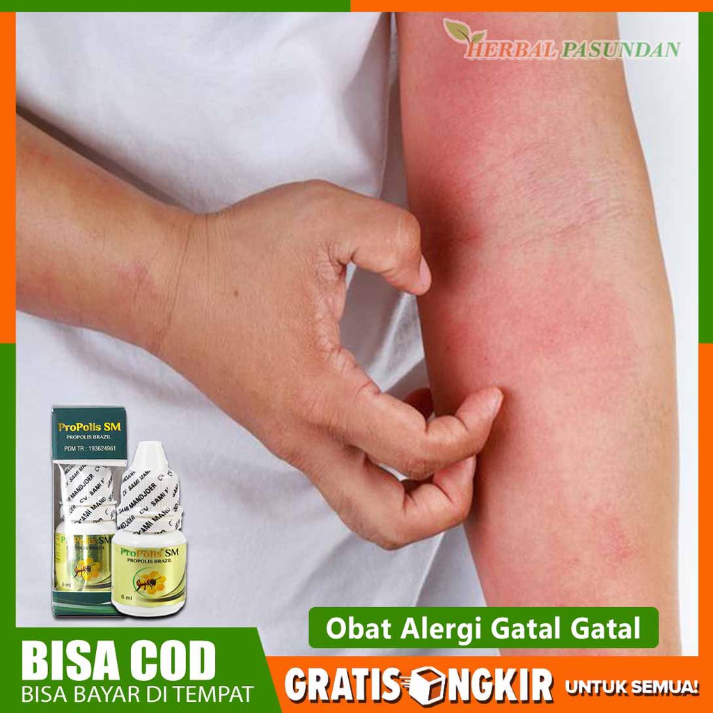 Obat alergi gatal gatal, alergi flu, alergi dingin, ruam kemerahan kulit, bengkak Propolis Sm Herbal
