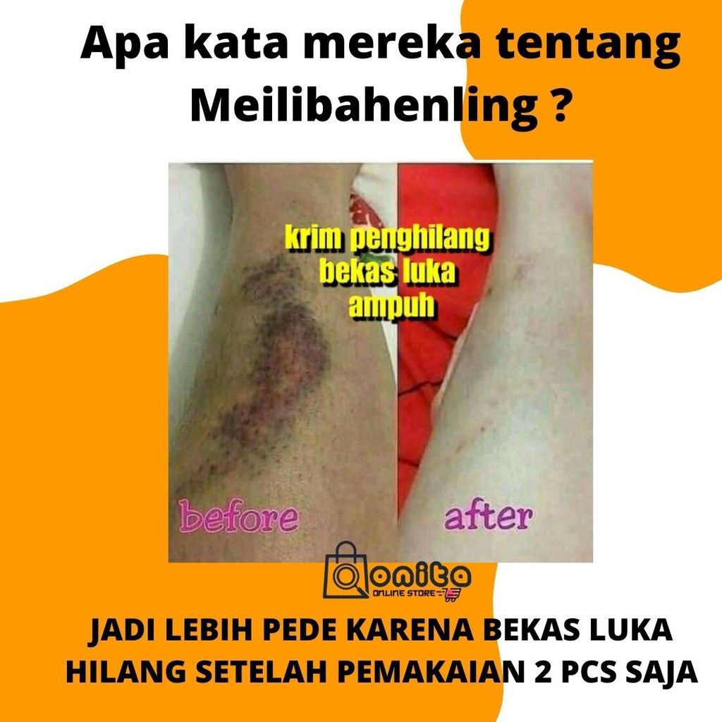 Meilibahenling Original 100% Obat Cream Penghilang Bekas Luka Lama Hitam Koreng Bopeng Ampuh BPOM Resmi Mengobati Luka Kulit Asli Halal Berkhasiat Untuk Menghilangkan Semua Jenis Bekas Luka Yang Mengandung Bahan Natural Alami Tanpa Efek Samping BIO HERBAL