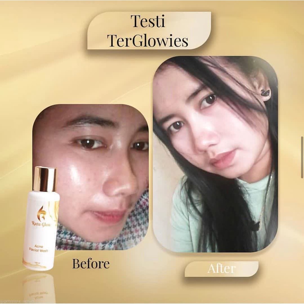 Ratu Glow Skincare Facial Wash Acne Membersihkan Kulit Berjerawat Yang Kotor