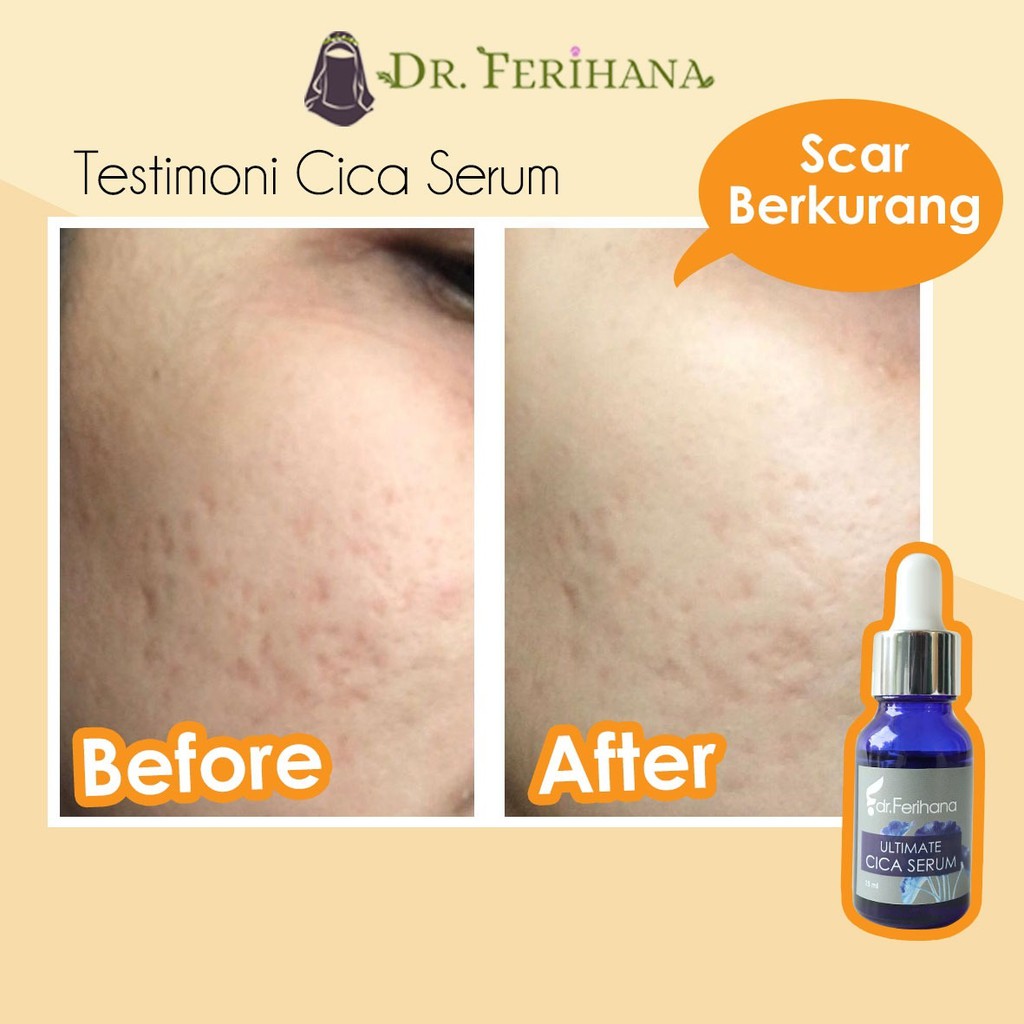 Ultimate Cica Serum dr. Ferihana Cosmetics &amp; Skincare Merupakan Produk Perawatan Wajah untuk Mengatasi Bopeng Scar Bekas Jerawat dan Luka Stretch Marks Selulit Kulit sensitif Memperbaiki Skin Barrier Sekaligus Anti Aging BPOM LPPOM HALAL MUI