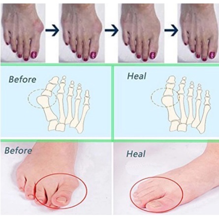 bunion Gel hammer toe pad bunion jari jari kaki BNN14