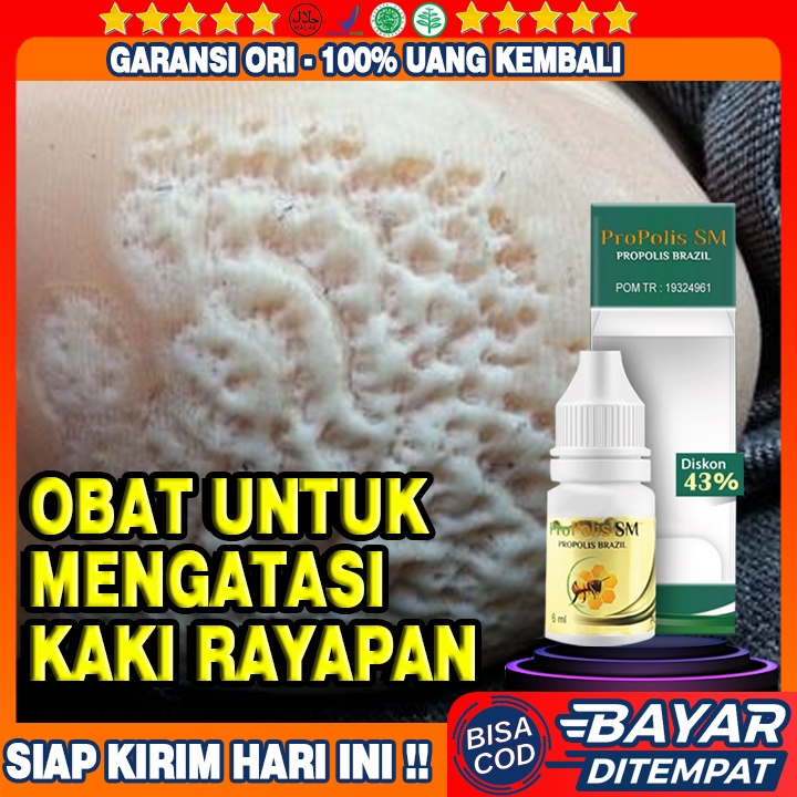 Obat Kaki Rayapan, Telapak Kaki Bolong Bolong, Telapak Kaki Berlubang, Pitted Keratolisis