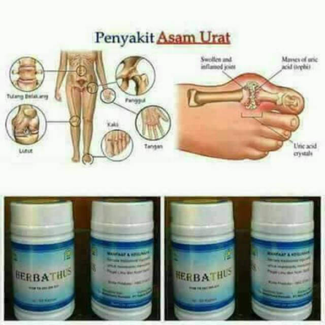 Herbathus nasa menurunkan kadar asam urat Original Nasa