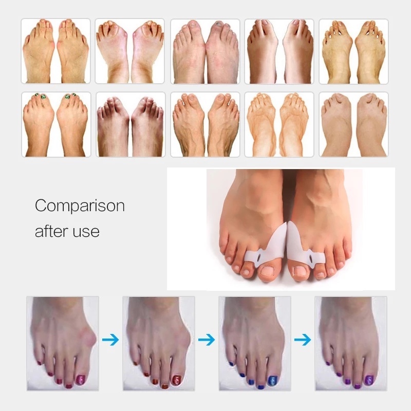 1 Pasang Bantalan Separator Jari Kaki Bahan Silikon Breathable Untuk Pereda Sakit / Korektor Bunion / Hallux Valgus