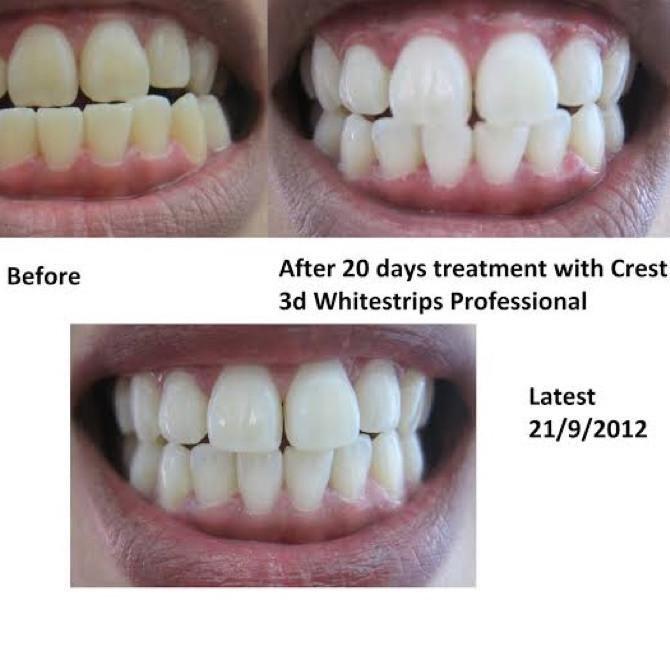 ➳ Oral B Whitestrips 3D Pemutih Gigi ➹