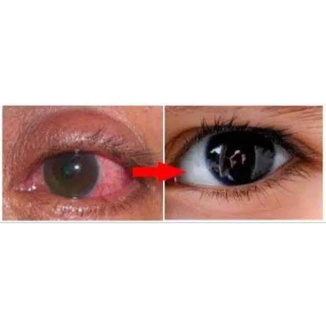 Slutena Asli S Lutena Original Obat Mata Ampuh Mengatasi Segala Masalah Mata