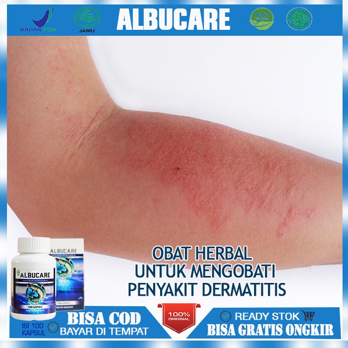 Obat Dermatitis, Obat Iritasi Pada Kulit, Obat Dermatitis Atopik (Eksim) , Obat Herbal Untuk Ruam Me