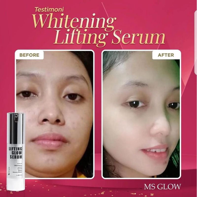 Lifting Whitening Serum 15 ml MS GLOW