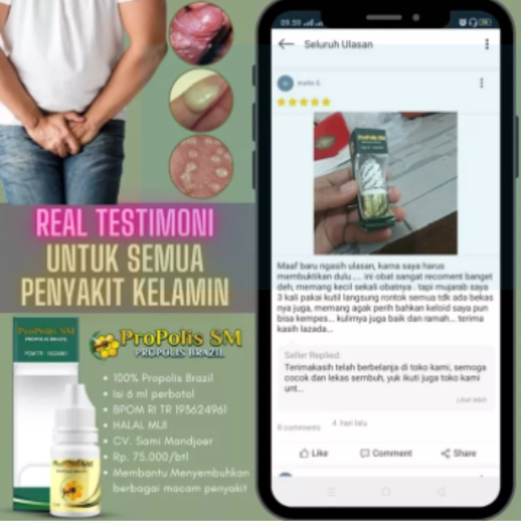 Obat Salep Salap Untuk Gatal Selangkangan, Obat Gatal Jamur Selangkangan, Obat Jamur Kulit Gatal Pada Kulit Gatel Bintik Binti Merah Lecet Luka Ruam Yang Membandel Menahun di Kemaluan Selangkangan Dengan Herbal PROPOLIS SM Asli 100% Original Bagus-6