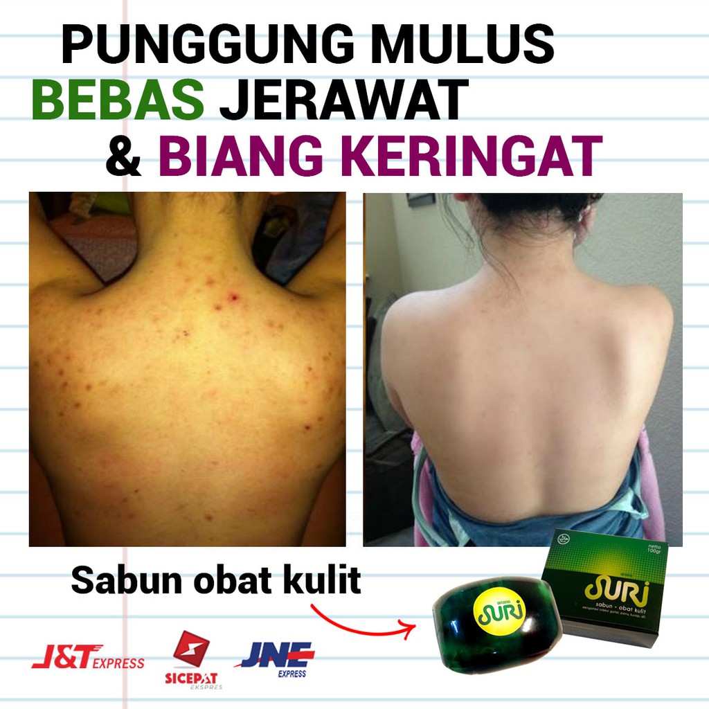 Obat Jerawat Punggung Biang Keringat – Sabun Suri