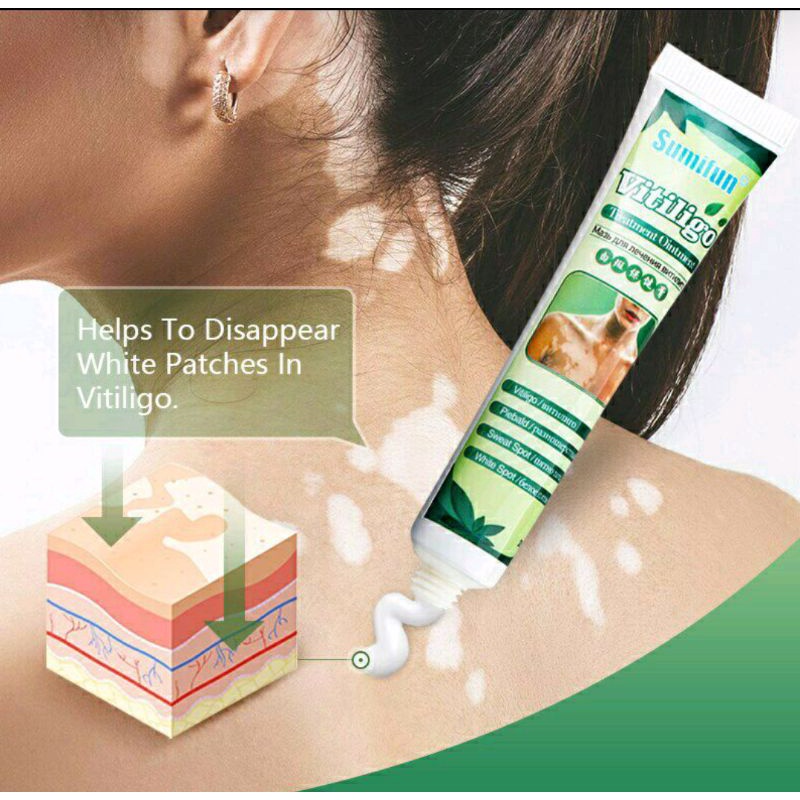 Sumifun Cream Salep Vitiligo Antibakteri