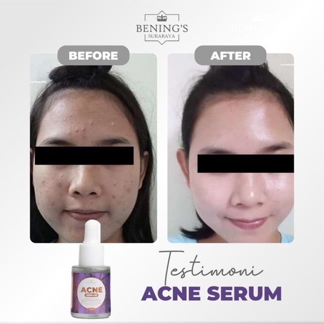 BENING'S SERUM ACNE | MENGATASI JERAWAT, BRUNTUSAN &amp; MENCERAHKAN | FREE GIFT SIAP KIRIM SELURUH INDONESIA