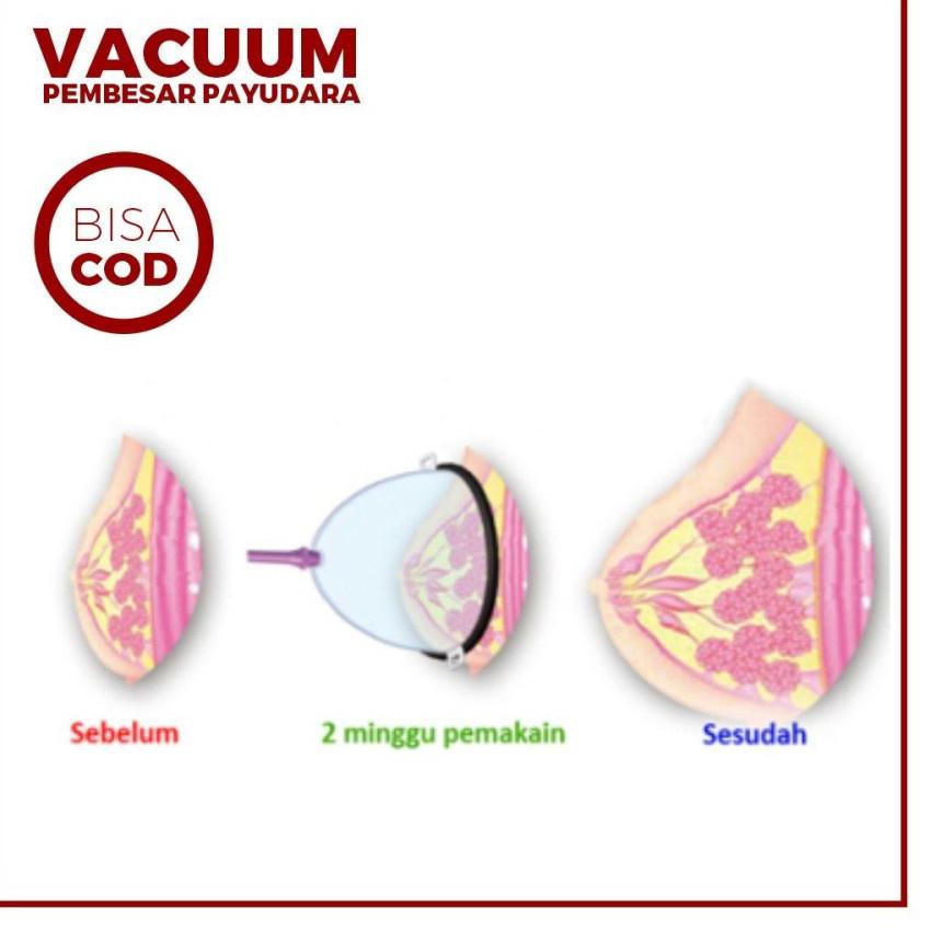 ♗ Paket Vacum Pembesar Kencang Pengencang Payudara / VACUM PAYUDARA / VACUM PEMBESAR PAYUDARA ☇