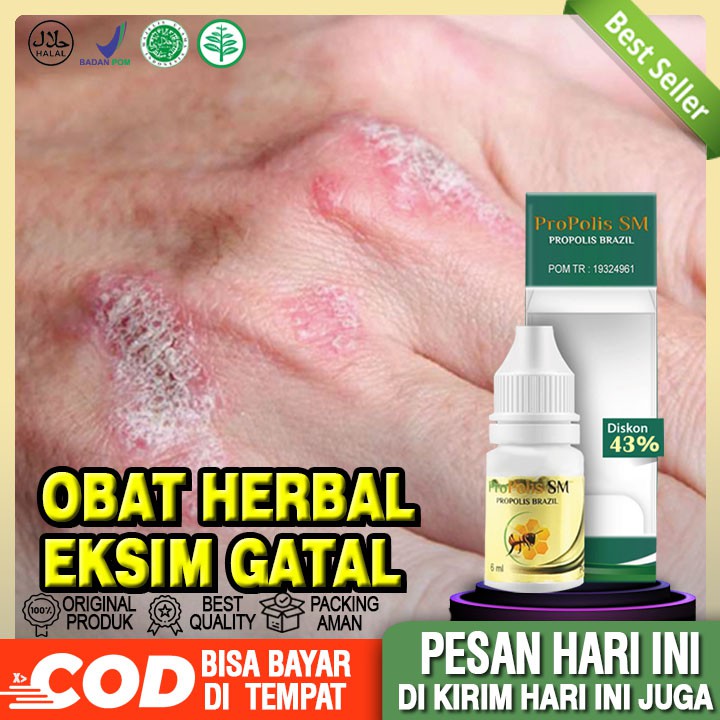 Obat Eksim Gatal, Eksim Di Wajah, Tangan, Kaki, Kepala | Propolis Sm